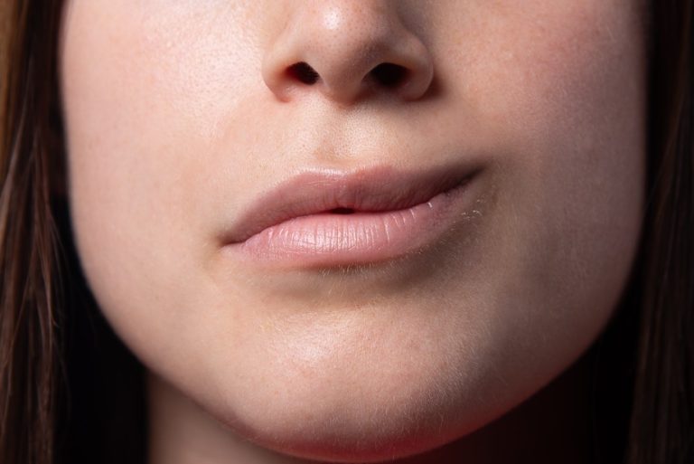 La importancia de reconocer los signos de una parálisis facial periférica