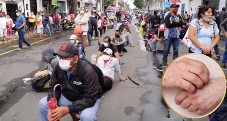 Perú declara emergencia sanitaria por brote de sarampión y activa alerta epidemiológica nacional