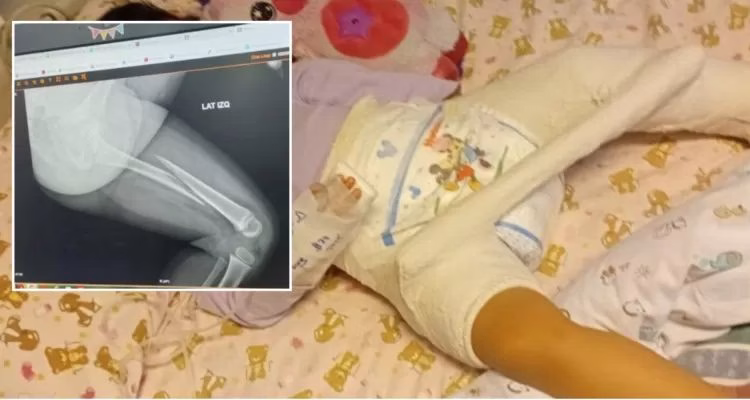 Fundación Integra deberá pagar indemnización tras fractura de fémur de niña en jardín infantil de La Araucanía